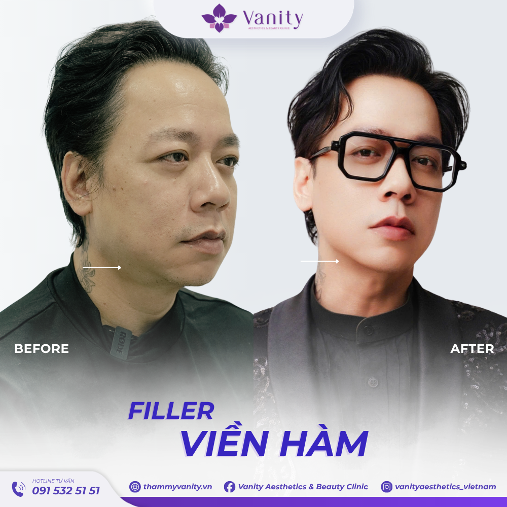 FILLER VIỀN HÀM